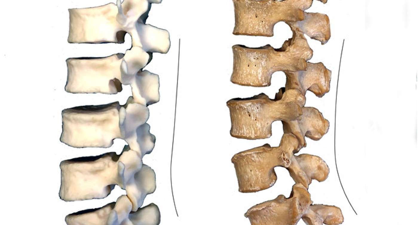 Neanderthals May Hold Clues as to Why Modern Humans Suffer Lower Back Pain 