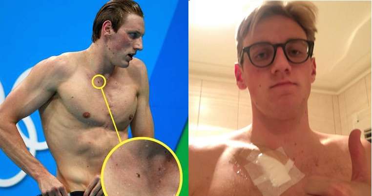 Anonymous Tip Saves Olympic Swimmer From Skin Cancer 